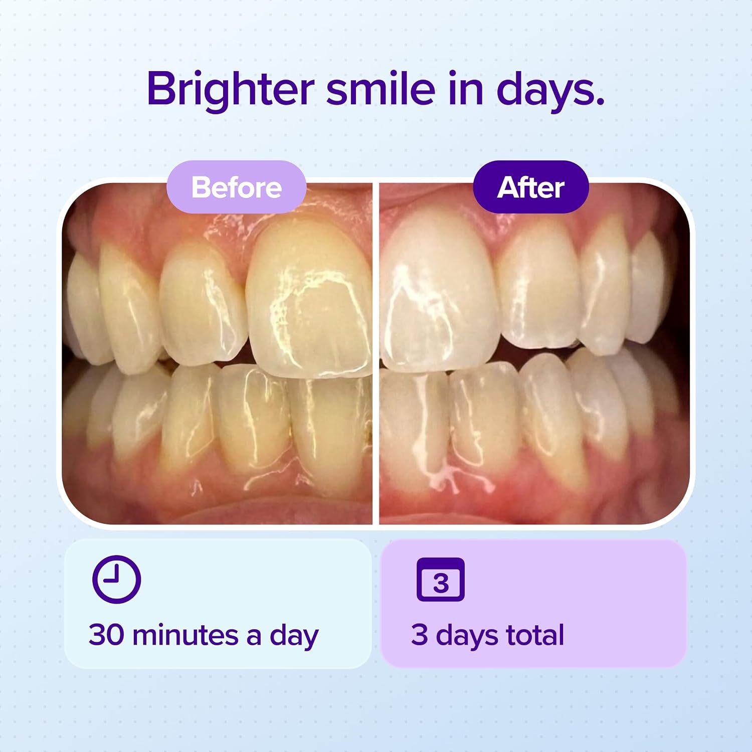 image:imageBURST Prefilled Teeth Whitening Trays 6 Trays3 Treatments 15 Hydrogen Peroxide for ProfessionalLevel Results Flexible 360 Teeth Whitening Gel Trays Aloe Coconut amp Xylitol Blend Teeth Trays