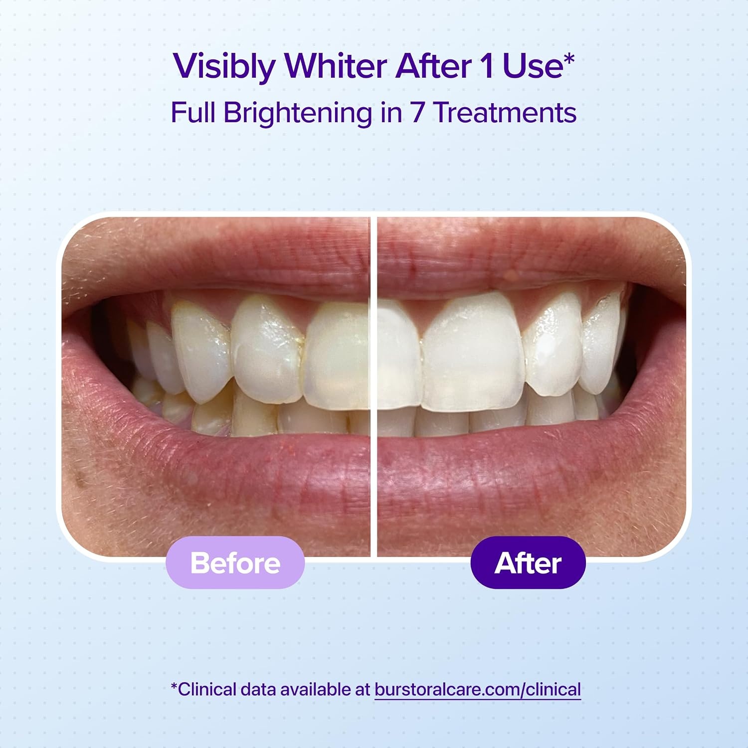 image:imageBURST Sensitive Teeth Whitening Strips Watermelon 20 Strips10 Treatments Each with 1 Upper1 Lower Visible Results in 15 Minutes NoSlip Grip EnamelSafe Whitening KitWatermelon